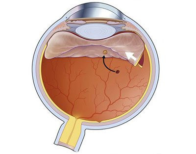 Vitreo-Retina